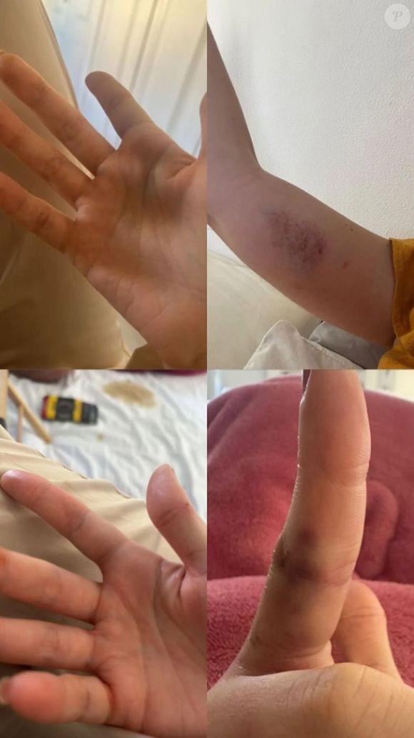 Uma amiga de Marcela Tomaszewski expôs na web os hematomas da miss que teriam sido provocados por Dado Dolabella