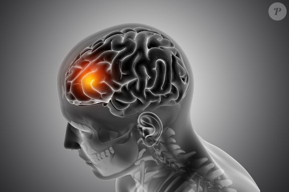 O AVC isquêmico é o tipo mais comum de derrame cerebral. Ele representa de 80% a 85% dos casos no Brasil e cerca de 978 pessoas são vítimas desta enfermidade por dia