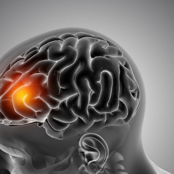 O AVC isquêmico é o tipo mais comum de derrame cerebral. Ele representa de 80% a 85% dos casos no Brasil e cerca de 978 pessoas são vítimas desta enfermidade por dia