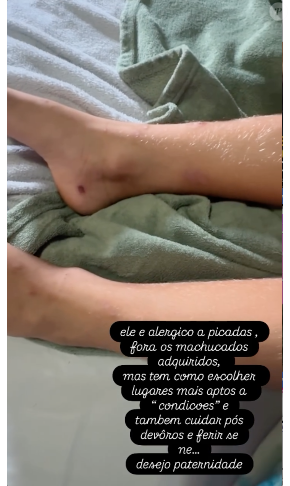 Luana Piovani disse que o filho é alérgico a picadas e mostrou todas as feridas em suas pernas