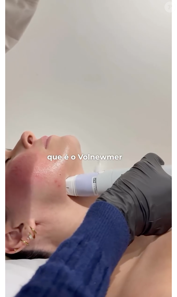 Ana Paula Renault também faz uso do Volnewmer, que estimula colágeno por meio de técnicas avançadas