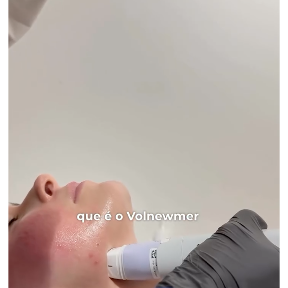Ana Paula Renault também faz uso do Volnewmer, que estimula colágeno por meio de técnicas avançadas