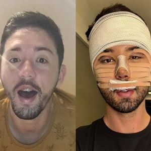 Antes e depois de Rico Melquiades: 40 fotos mostram mudança radical do influenciador com procedimentos estéticos