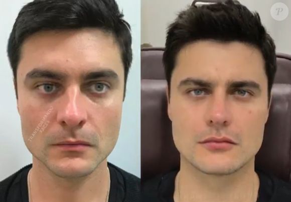 Guilherme Leicam antes e depois da harmonização facial
