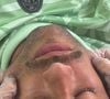 Segundo a Dra. Juliana Neiva, "o tratamento é voltado principalmente para combater a flacidez, estimular a produção de colágeno e melhorar a firmeza e o contorno da pele, sem cirurgia"