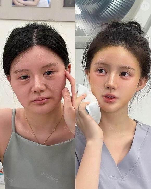 Antes e depois das cirurgias do Dr. Lifeng deixam internautas chocados
