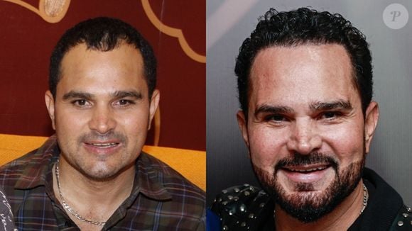 Um dos primeiros famosos a fazer o transplante capilar foi Luciano Camargo, que ficou muito mais jovem após a técnica