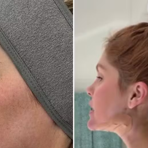 Bárbara Evans decidiu testar mais uma alternativa estética para suavizar a papada no pescoço — região que, segundo ela, a incomoda há anos.