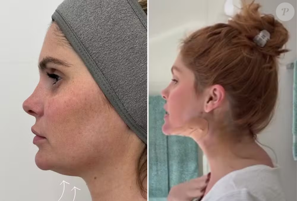 Bárbara Evans decidiu testar mais uma alternativa estética para suavizar a papada no pescoço — região que, segundo ela, a incomoda há anos.