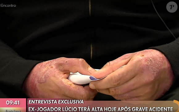 Ex-jogador Lúcio teve parte do corpo queimado, como as mãos, após o acidente.