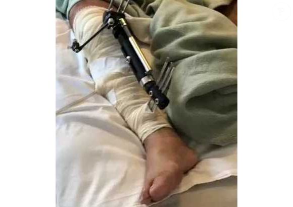 Raymundo de Souza teve a perna necrosada por conta de uma infecção no hospital