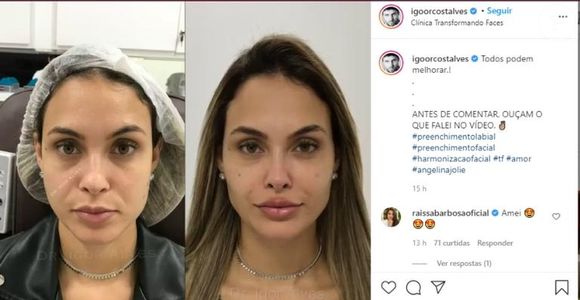 Já harmonizada, Sarah Andrade investiu em uma nova harmonização para definir mais seu rosto e contornos