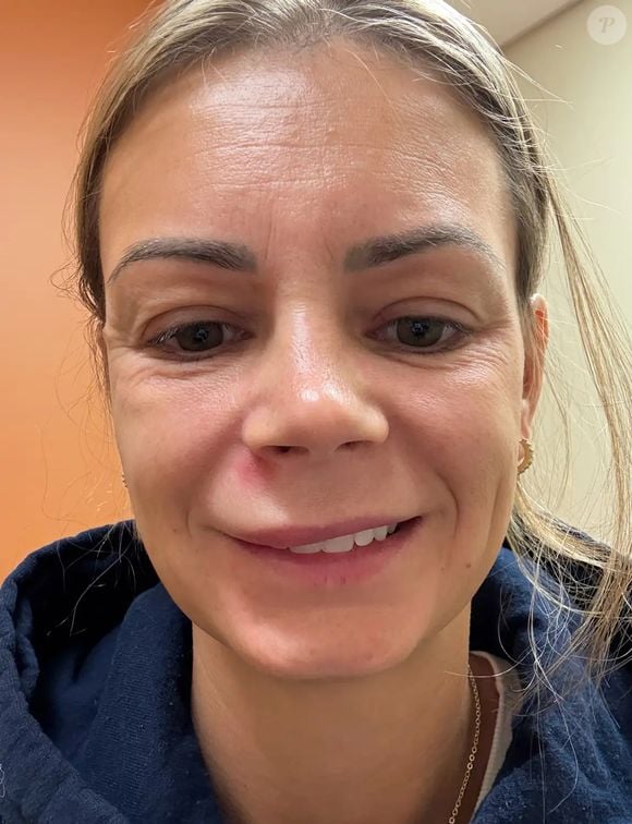 Assustada, ela desistiu da tentativa, higienizou novamente o rosto e aplicou um curativo específico para acne. Ao pesquisar sobre o ocorrido, descobriu informações sobre o chamado “triângulo da morte”, região que vai da ponta do nariz até os cantos da boca.