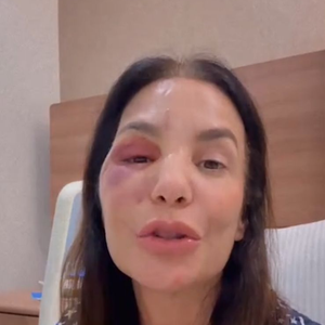 Ivete Sangalo explica cirurgia no rosto após queda causada por desidratação e pressão baixa