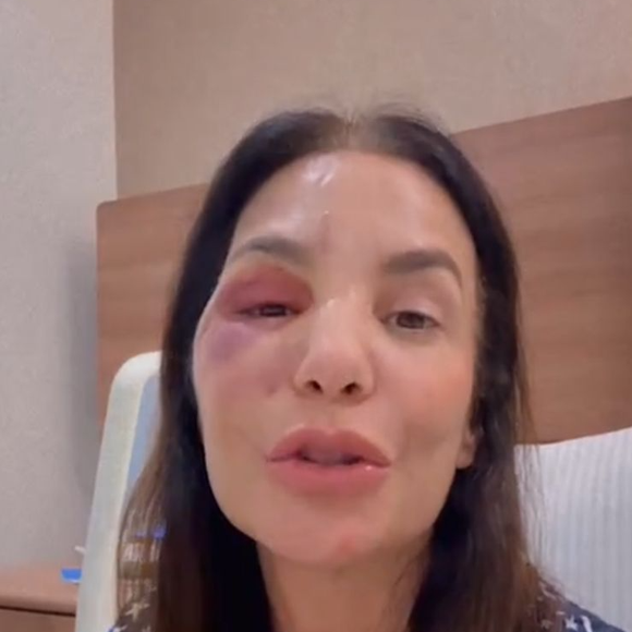 Ivete Sangalo explica cirurgia no rosto após queda causada por desidratação e pressão baixa