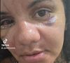 Juliana Soares contou que mesmo após 30 dias da cirurgia ainda tem ematomas no rosto