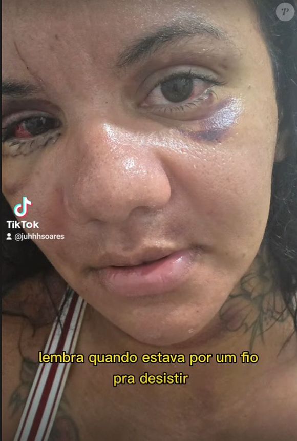 Juliana Soares contou que mesmo após 30 dias da cirurgia ainda tem ematomas no rosto