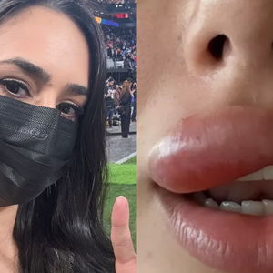 Médicas explicam problema de saúde que inchou a boca de Bruna Biancardi: ‘Pode evoluir para uma meningite ou outra complicação maior’