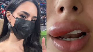 Médicas explicam problema de saúde que inchou a boca de Bruna Biancardi: ‘Pode evoluir para uma meningite ou outra complicação maior’