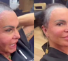 Gretchen relata que micropigmentação piorou o estado de sua alopecia; médicos debatem sobre complicações do procedimento: ‘Pode desencadear processos inflamatórios’