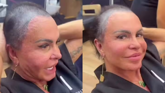 Gretchen relata que micropigmentação piorou o estado de sua alopecia; médicos debatem sobre complicações do procedimento: ‘Pode desencadear processos inflamatórios’