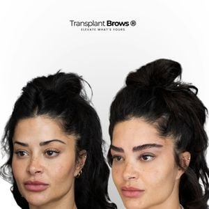 Aline Campos entra na onda do transplante e reforça busca por naturalidade: 'O transplante de sobrancelha pode ser uma excelente solução em casos de falhas definitivas', explica Dra. Rebecca Atman