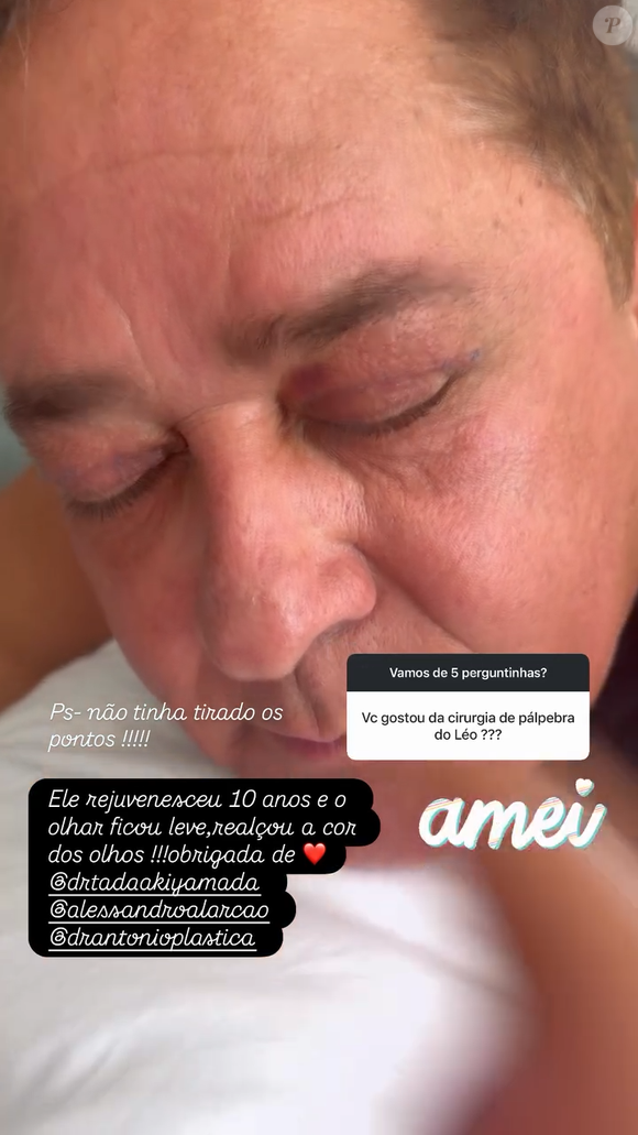 Blefaroplastia: Leonardo se tornou adepto da cirurgia plástica mais popular do mundo em 2024 e em 2025