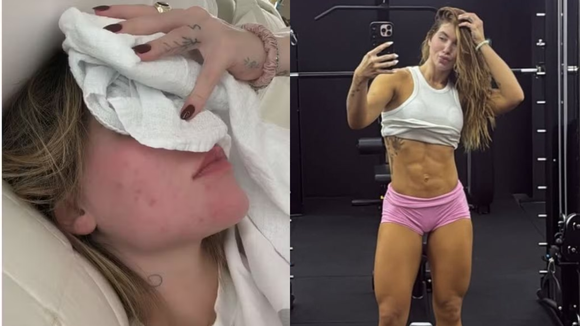 Treinar pode causar crises de enxaqueca? Médico tira dúvidas após Virgínia revelar mudanças em exercícios devido ao diagnóstico: ‘Priorizar regularidade em vez de intensidade’