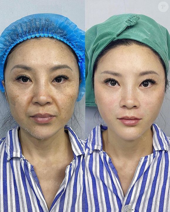 Dr. Lifeng promete e cumpre o rejuvenescimento de suas pacientes