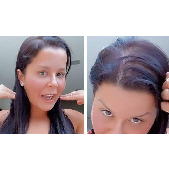 Maraisa convive com alopecia, uma doença que causa perda de cabelo.