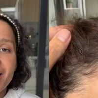 'Não conseguia olhar no espelho': Maiara, dupla de Maraisa, posta vídeo com emocionante desabafo sobre sua alopecia androgenética
