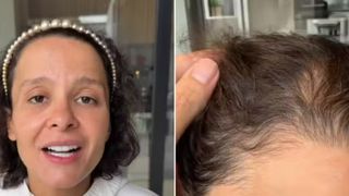 'Não conseguia olhar no espelho': Maiara, dupla de Maraisa, posta vídeo com emocionante desabafo sobre sua alopecia androgenética