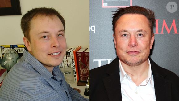 Antes e depois: Elon Musk também se tornou famoso a passar por implante capilar