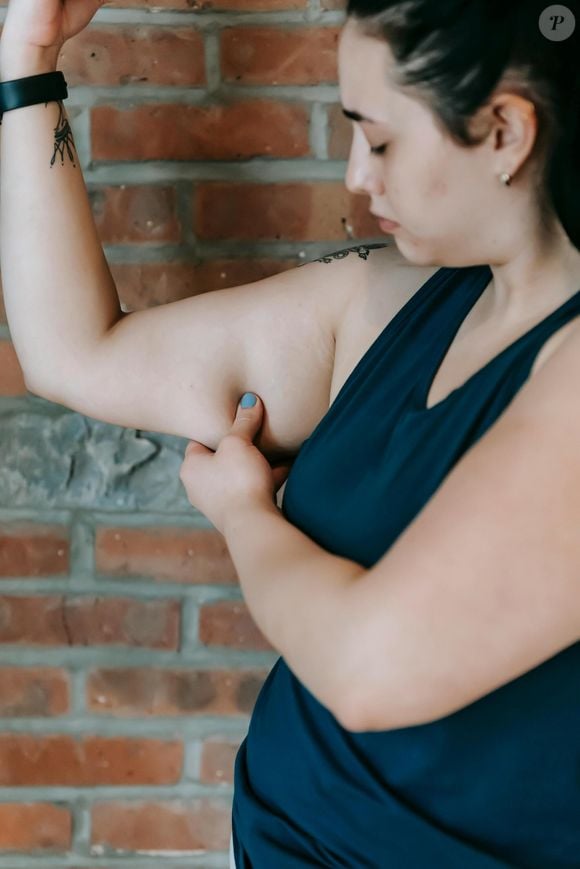 A flacidez nos braços é popularmente conhecida como o 'músculo do tchauzinho', sendo um dos principais incômodos das mulheres