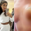 Uma mãe de 5 filhos voou à Turquia para uma cirurgia de silicone. Semanas depois, ela ainda está lá e já gastou milhares a mais do que planejou