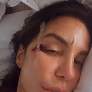 Ivete Sangalo apresentou cortes na testa e na lateral do olho direito