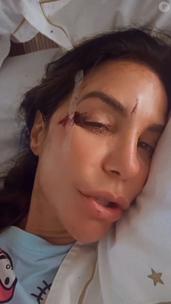 Ivete Sangalo apresentou cortes na testa e na lateral do olho direito