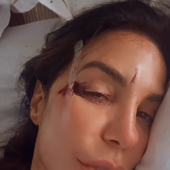 Ivete Sangalo apresentou cortes na testa e na lateral do olho direito