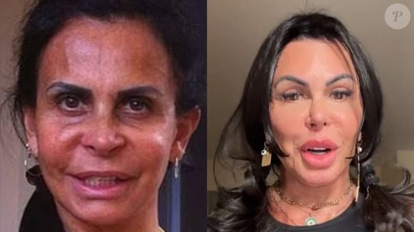 Gretchen aposta no botox e preenchimentos para manter seu olhar mais levantado e livre de rugas