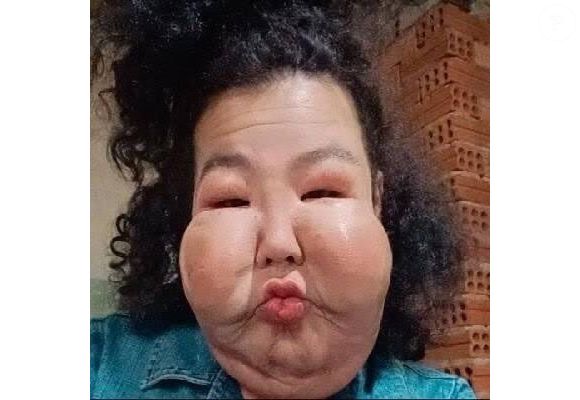 Juju do Pix foi comparada ao personagem Fofão por conta do rosto após aplicação de óleo mineral: 'Não tenho culpa de ter chegado à proporção que chegou'