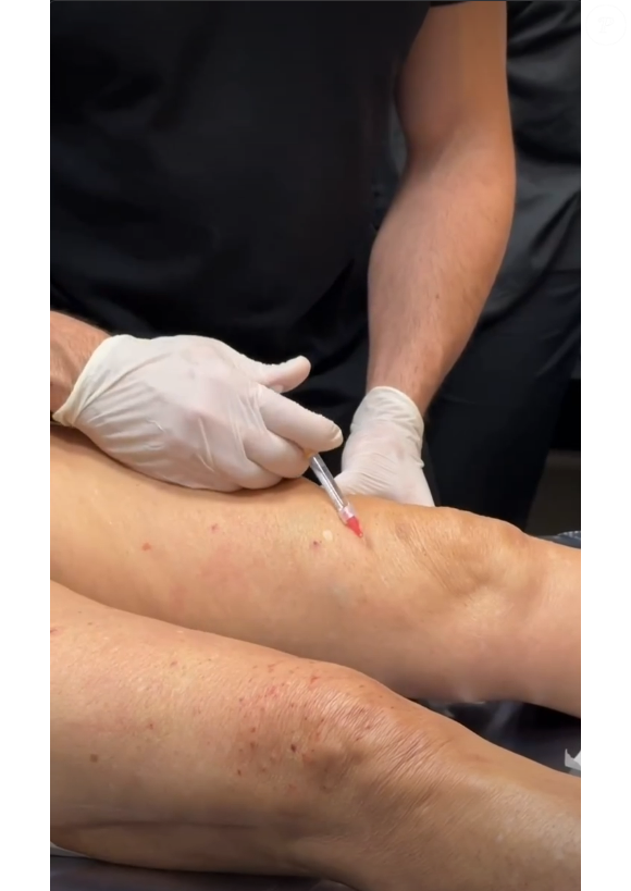 Bioestimuladores e tecnologias modernas entram em cena contra a flacidez corporal: 'Hoje sabemos que tratar a flacidez corporal exige uma abordagem combinada', destaca o dermatologista Daniel Coimbra