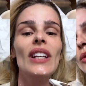 Botox Nefertiti: o procedimento queridinho das celebridades chega ao rosto de Yasmin Brunet