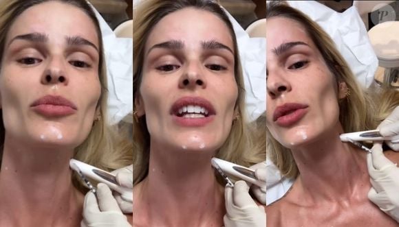 Botox Nefertiti: o procedimento queridinho das celebridades chega ao rosto de Yasmin Brunet