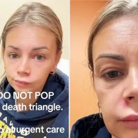 Mulher acaba em pronto-socorro após espremer espinha no 'triângulo da morte' - área do rosto 'pode levar a uma infecção no cérebro'. Entenda!