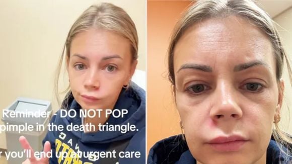 Mulher acaba em pronto-socorro após espremer espinha no 'triângulo da morte' - área do rosto 'pode levar a uma infecção no cérebro'. Entenda!