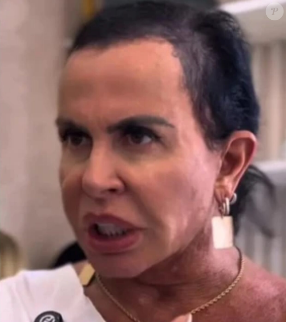 Gretchen voltou a abrir o coração sobre sua vivência com a alopecia androgenética, uma condição que causa afinamento progressivo dos fios e queda de cabelo