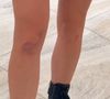 Jade Picon mostrou hematomas nos braços e nas pernas