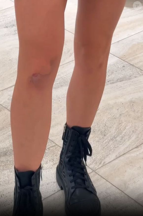 Jade Picon mostrou hematomas nos braços e nas pernas