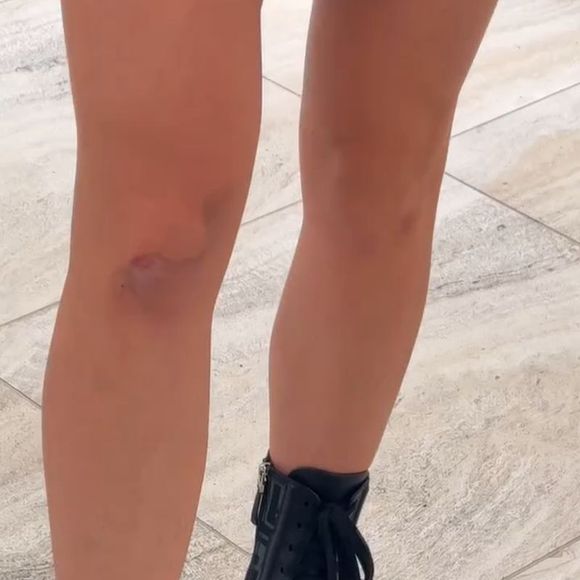 Jade Picon mostrou hematomas nos braços e nas pernas