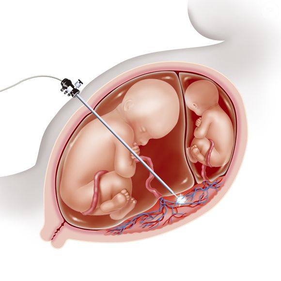 Também conhecida como Síndrome da Transfusão de Gêmeos, a condição ocorre quando os dois bebês compartilham uma única placenta